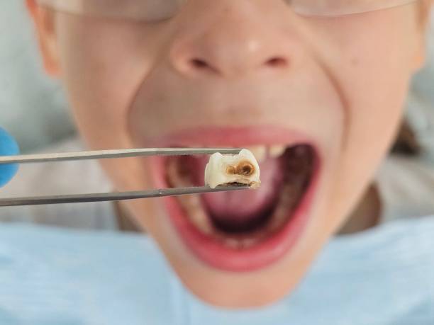Best Emergency Treatment for Dental Infections or Abscesses in Enon, VA